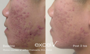 Before Acne Treatment 1