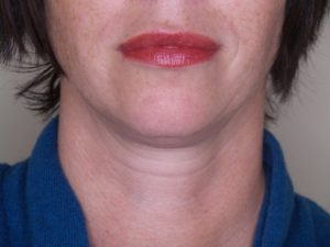 After Juvederm with Lipstick